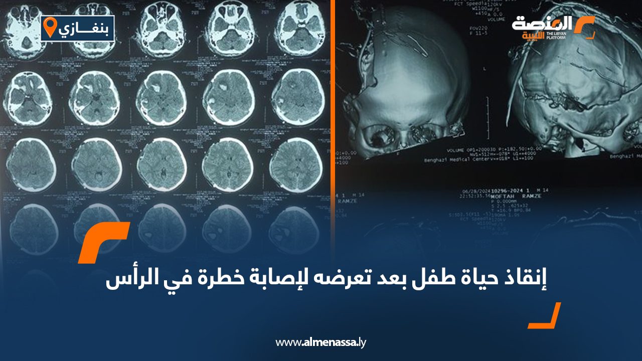 Wide-Web-1251 إنقاذ حياة طفل بعد تعرضه لإصابة خطرة في الرأس