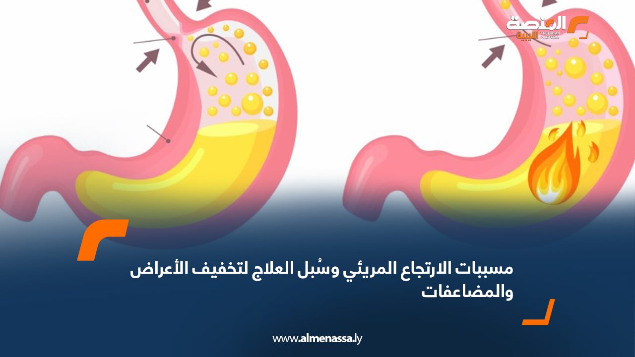 مسببات الارتجاع المريئي وسُبل العلاج لتخفيف الأعراض والمضاعفات