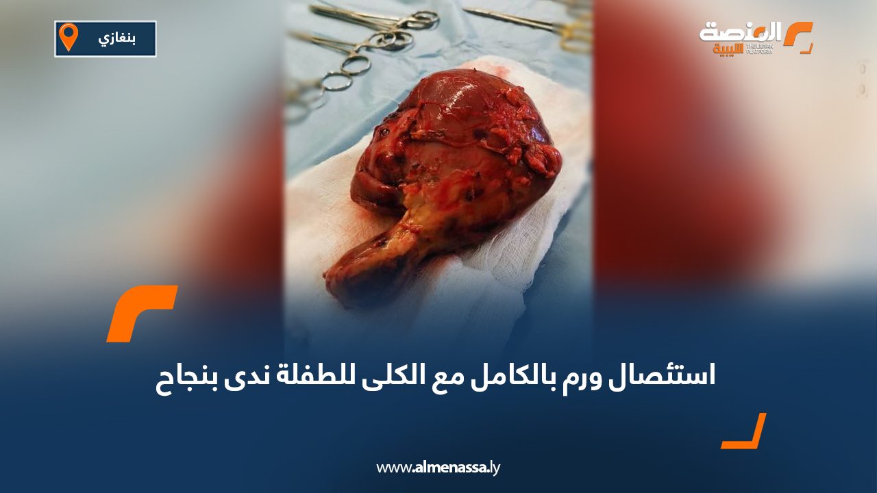 استئصال ورم بالكامل مع الكلى للطفلة ندى بنجاح استئصال ورم بالكامل مع الكلى للطفلة ندى بنجاح